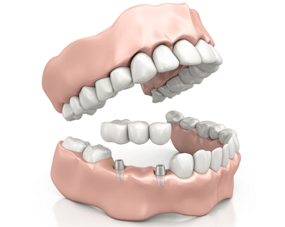 Dental implants Farringdon